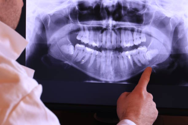 Best Knocked-Out Tooth (Avulsed Tooth) Treatment in Republic, WA