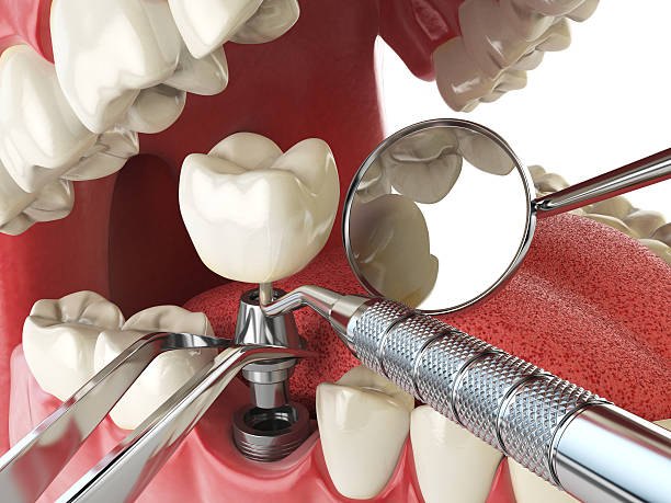 Best Broken or Chipped Tooth Repair in Republic, WA